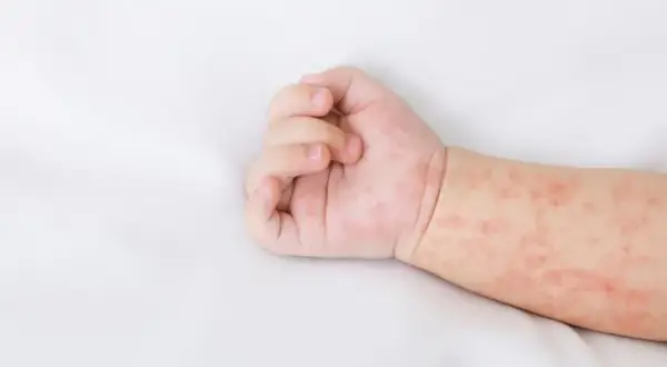 Jak wygląda odparzenie u niemowlaka? Objawy, przyczyny i leczenie