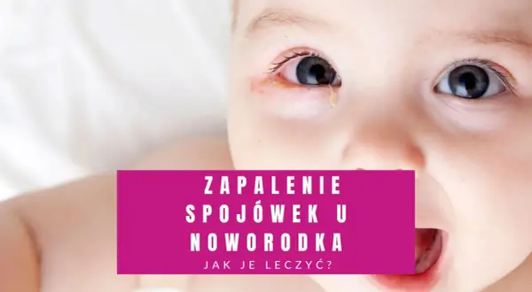 Co na zapalenie spojówek u niemowlaka - objawy, leczenie i profilaktyka